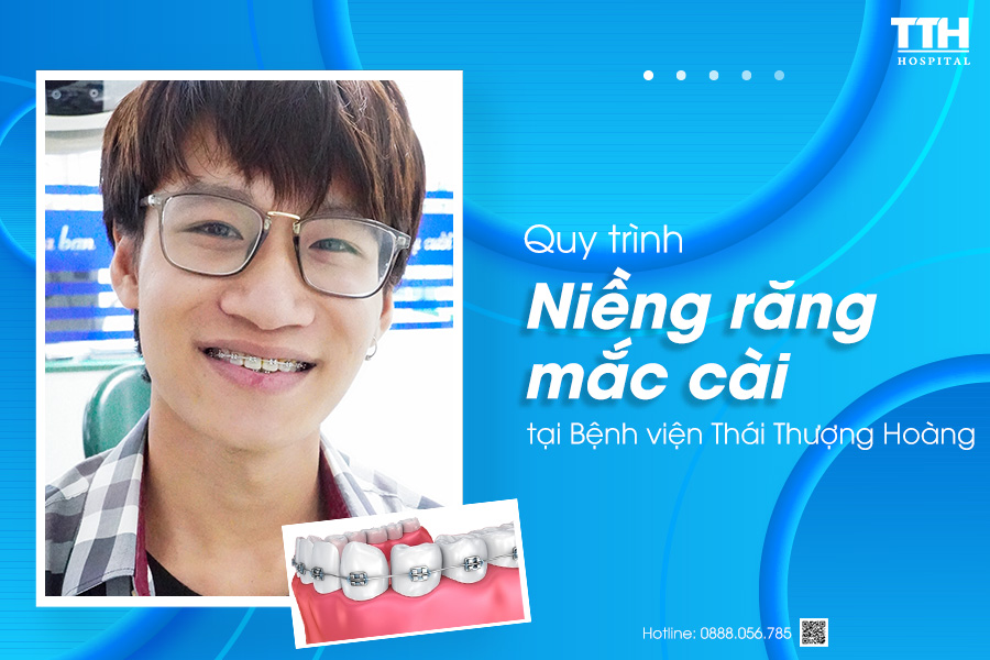 Quy trình niềng răng mắc cài tại Thái Thượng Hoàng